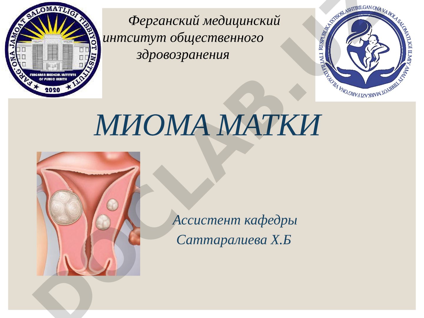 Миома матки