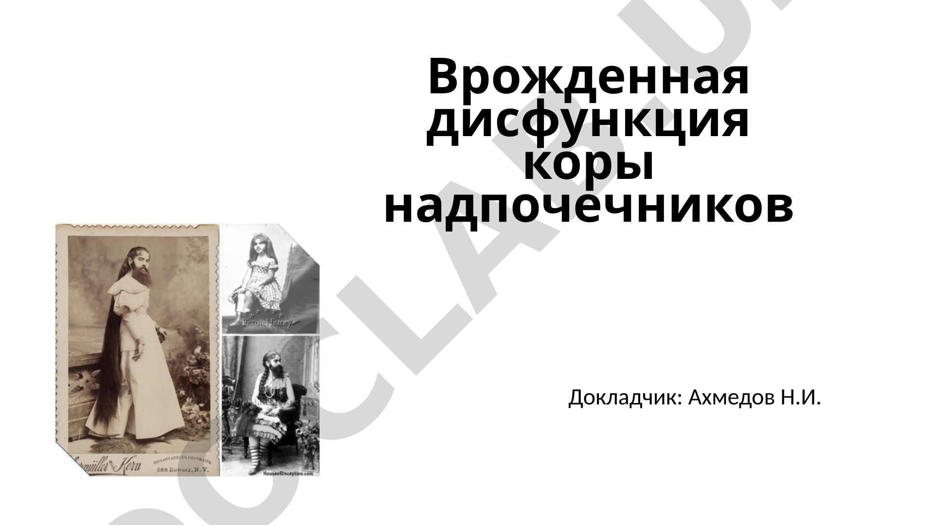 Врожденная дисфункция коры надпочечников