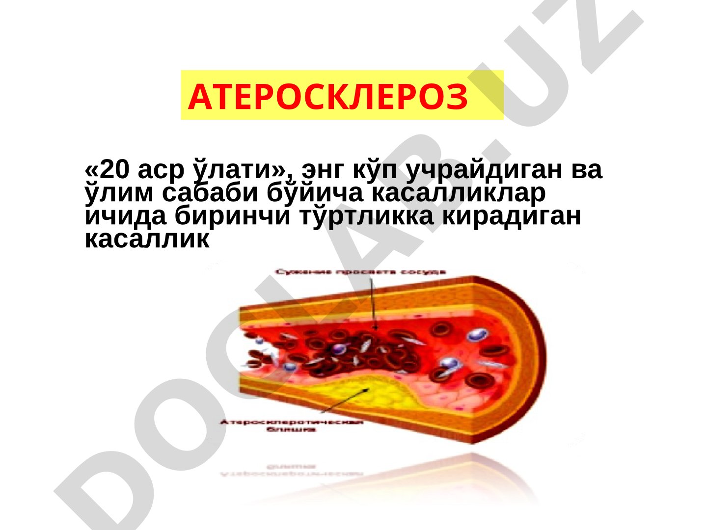Атеросклероз