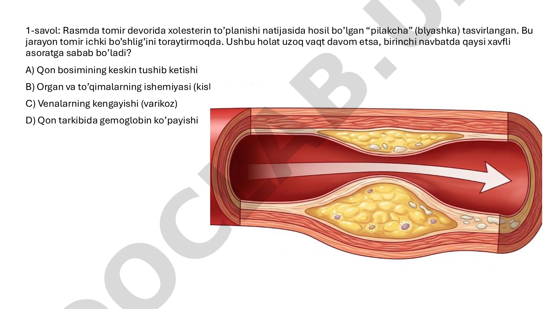 Ateroskleroz va gipertoniya asoratlari bo'yicha test savollari