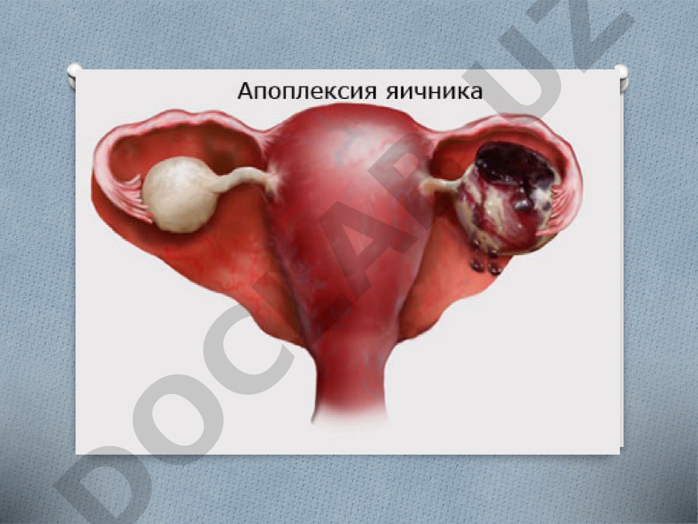 Этиология, патогенез, классификация, диагностика и лечение геморрагической кисты яичника