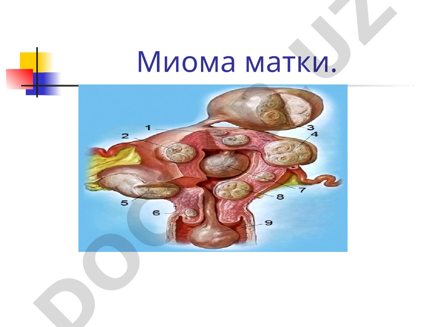Миома матки: определение, происхождение, эпидемиология