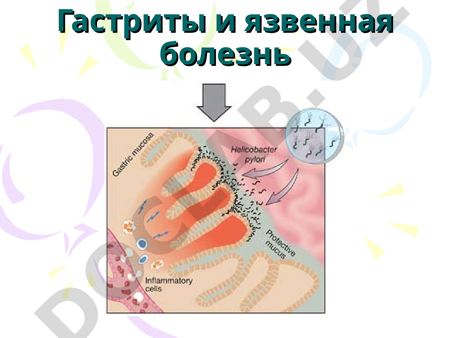 Открытие Helicobacter pylori как причины гастрита и язвы