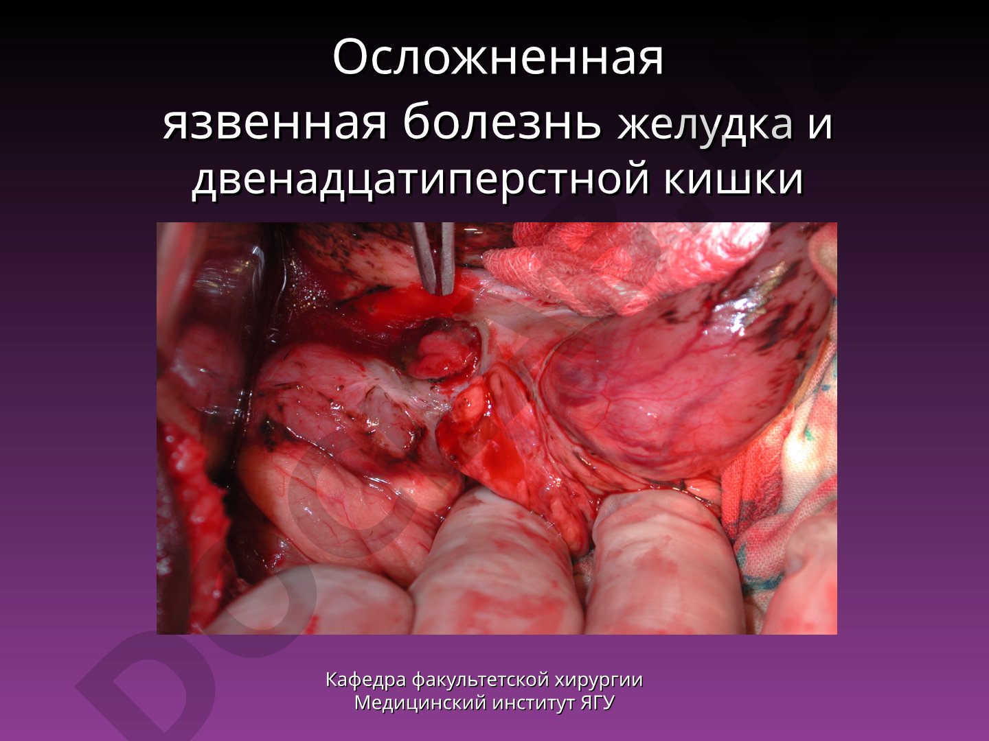 Осложненная язвенная болезнь желудка и двенадцатиперстной кишки