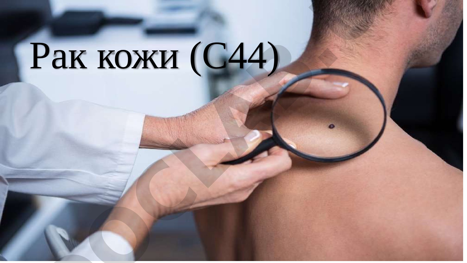 Базальноклеточный рак кожи (С44)