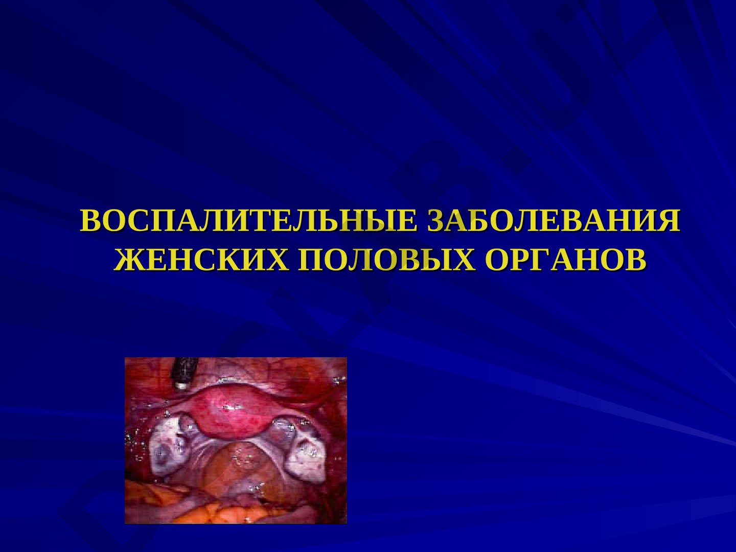 Воспалительные заболевания женских половых органов