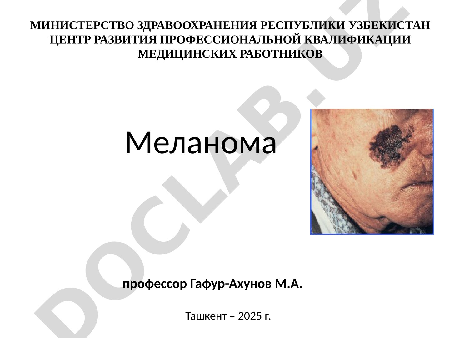 Меланома кожи: динамика заболеваемости и выживаемости в Узбекистане
