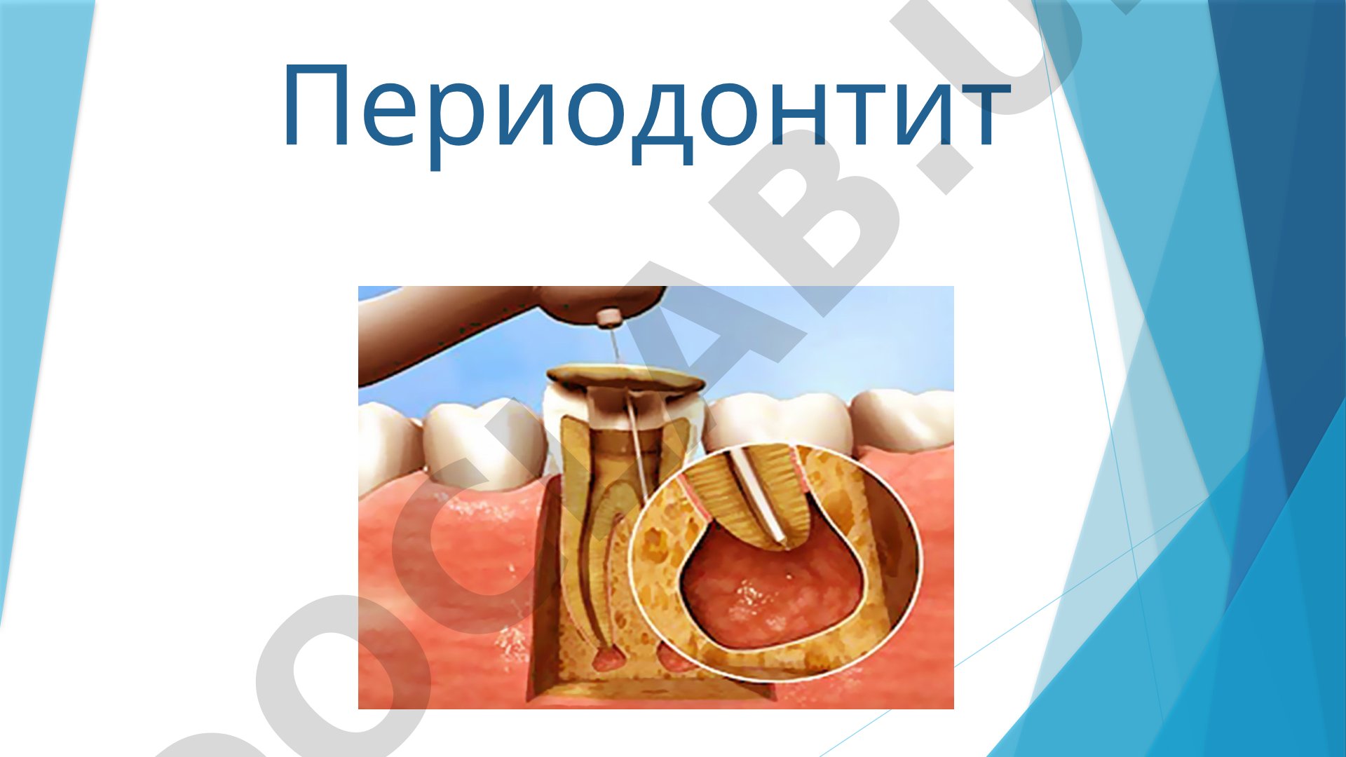 Периодонтит: комплексная терапия