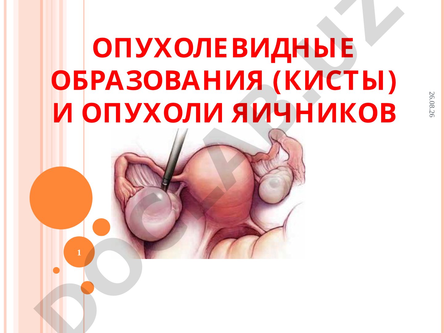 Опухолевидные образования (кисты) и опухоли яичников