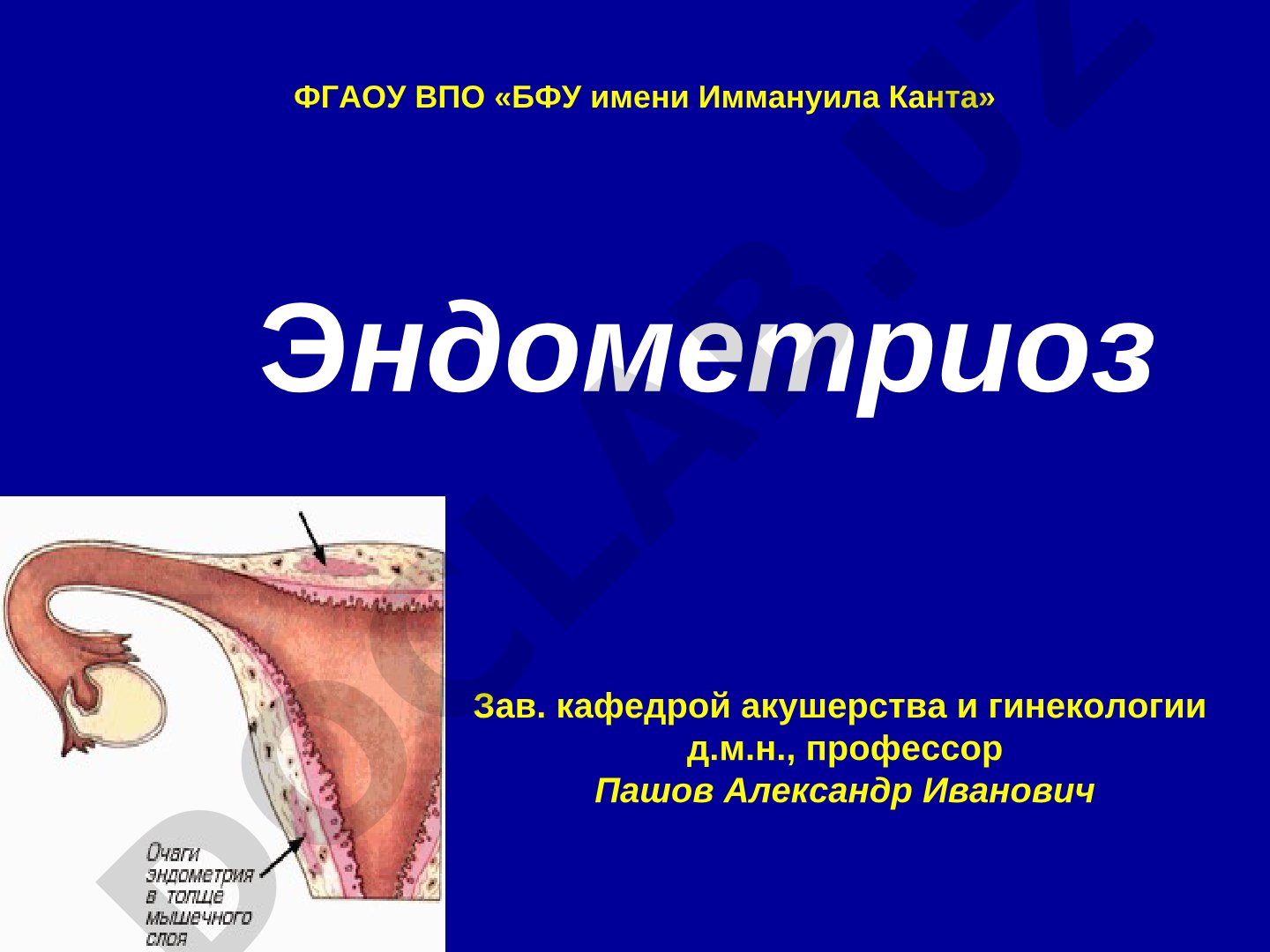 Лекция по эндометриозу: определение, патогенез, классификация, диагностика, лечение