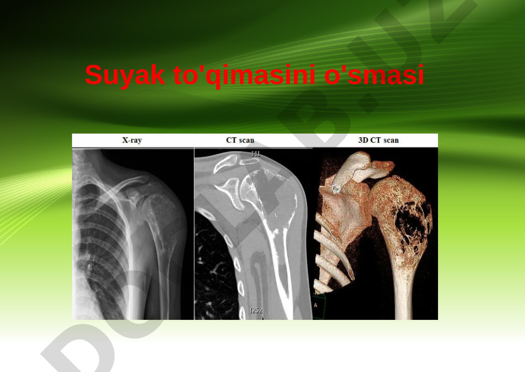 Suyak to'qimasini o'smasi