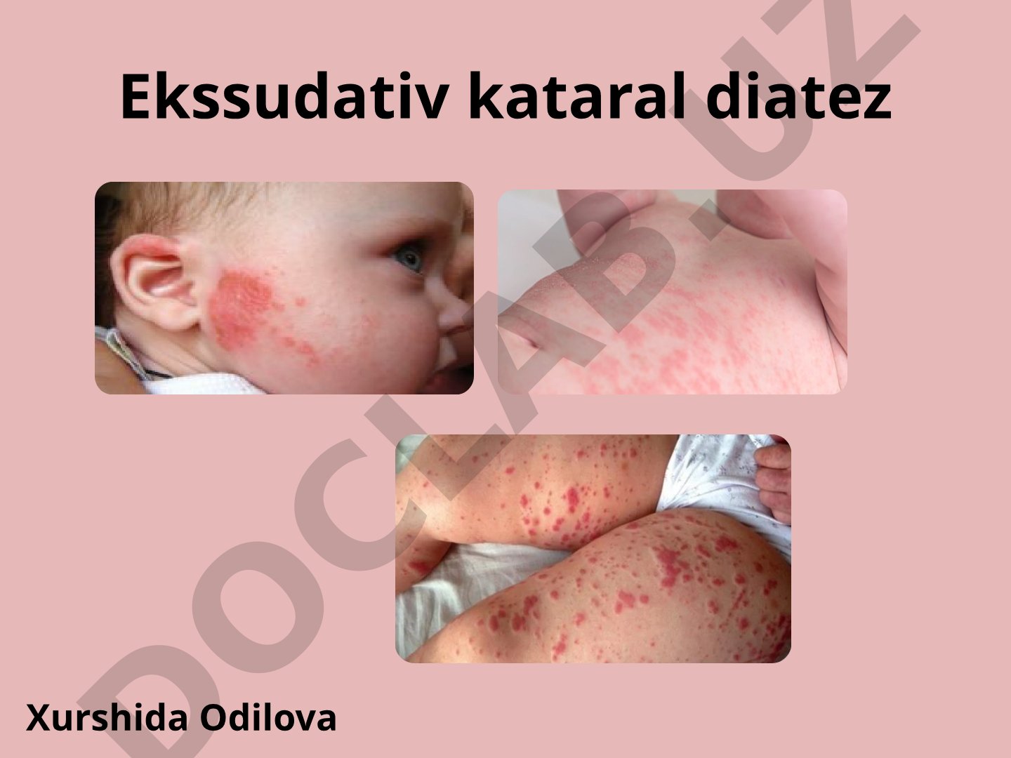 Ekssudativ kataral diatez