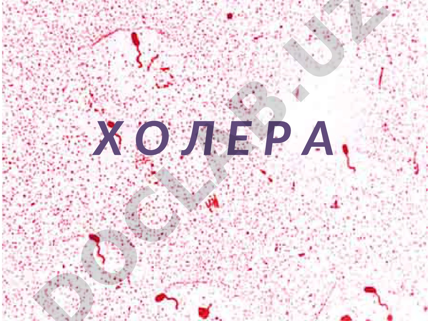 Холера: острое инфекционное заболевание
