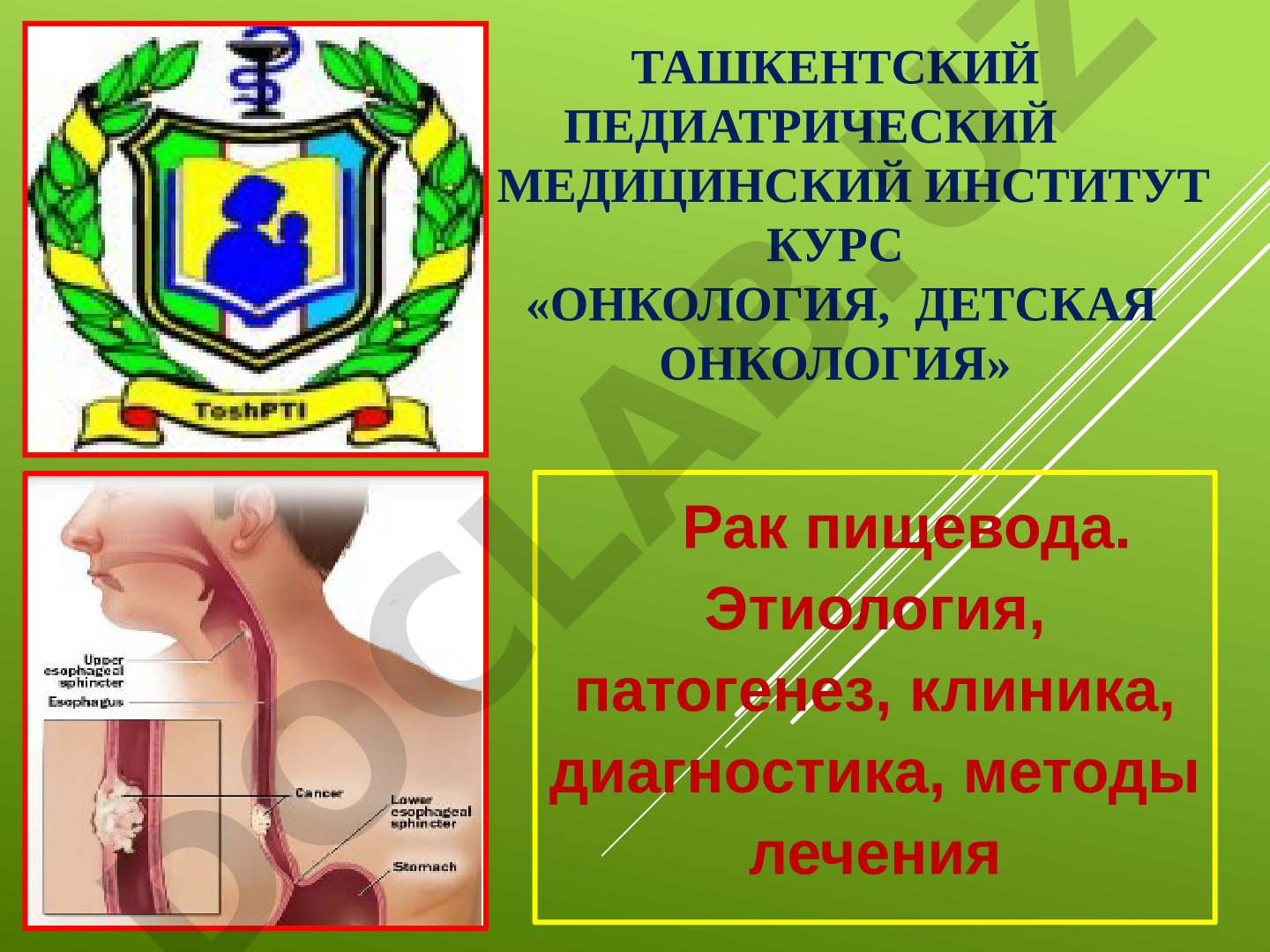 Рак пищевода. Этиология, патогенез, клиника, диагностика, методы лечения
