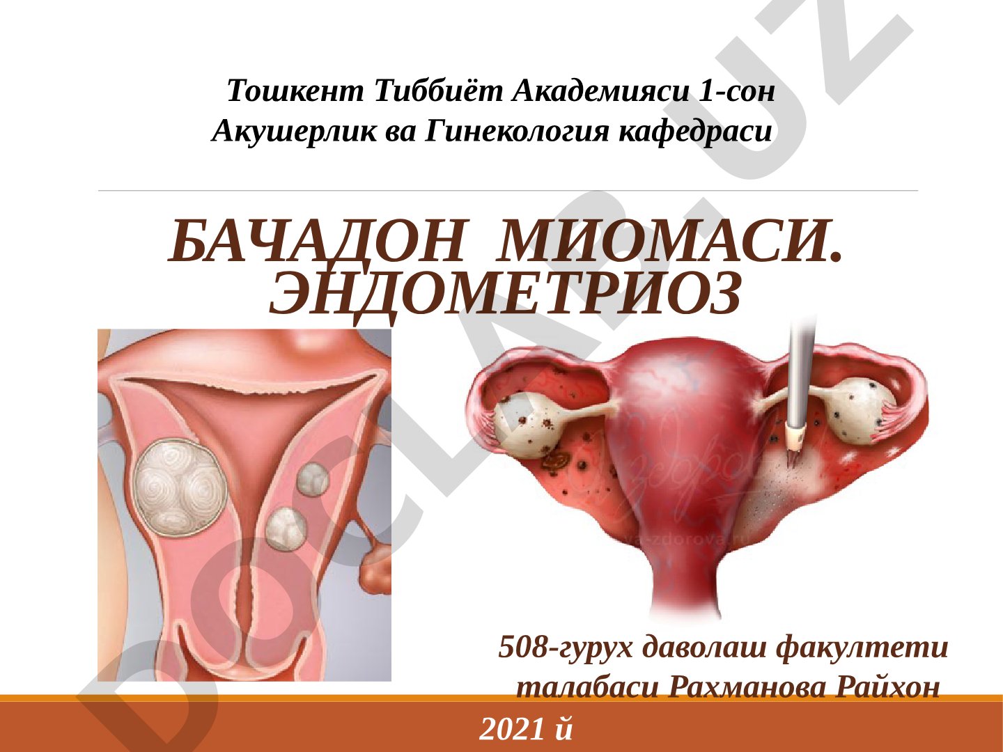 Бачадон миомаси. эндометриоз