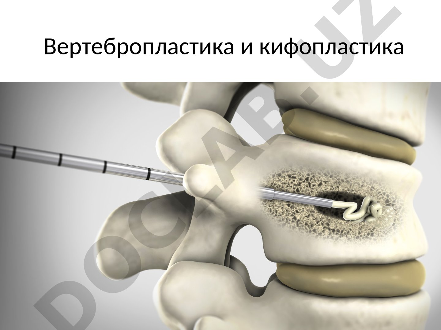 Вертебропластика и кифопластика