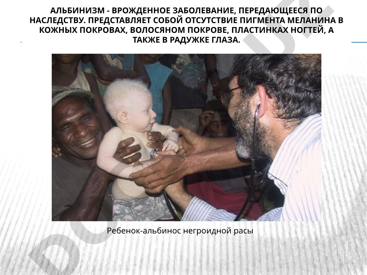Альбинизм - врожденное заболевание, передающееся по наследству.