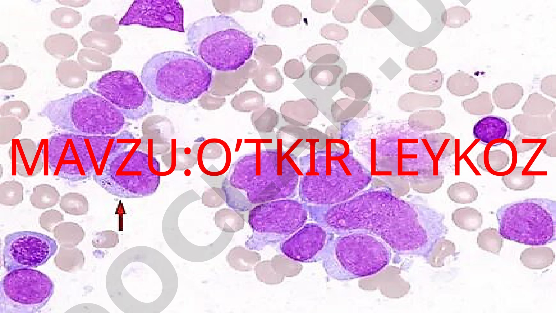 O'tkir leykoz (leykemiya) - qon hujayralarining saratoni