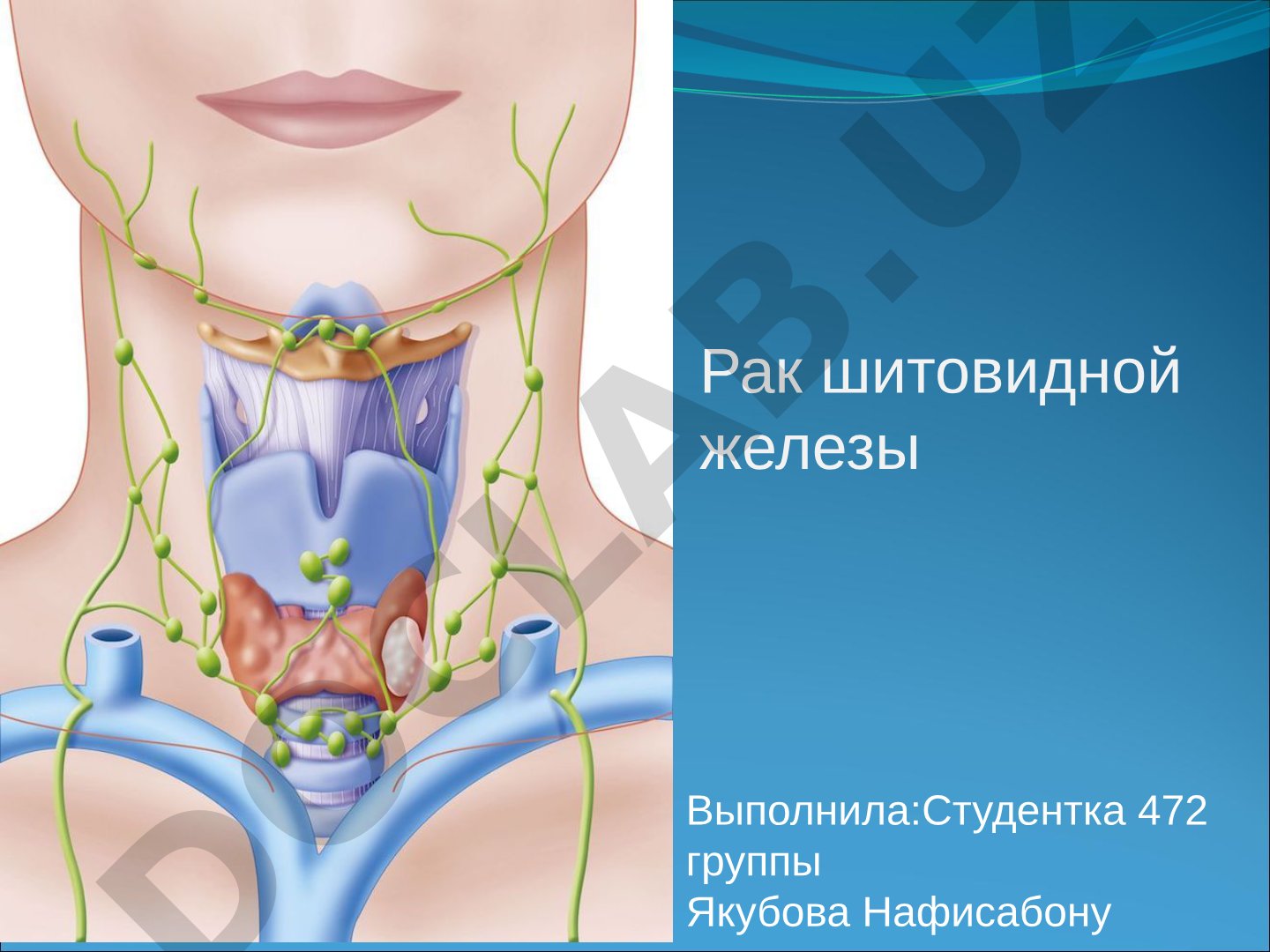 Рак щитовидной железы