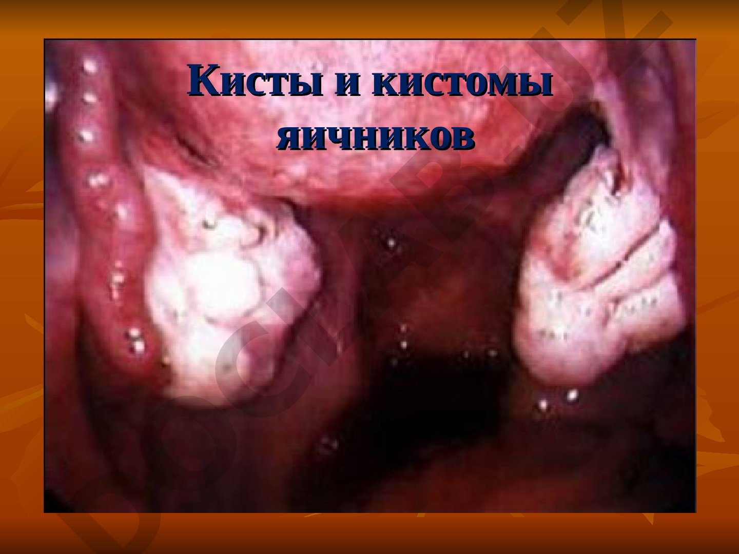 Кисты и кистомы яичников