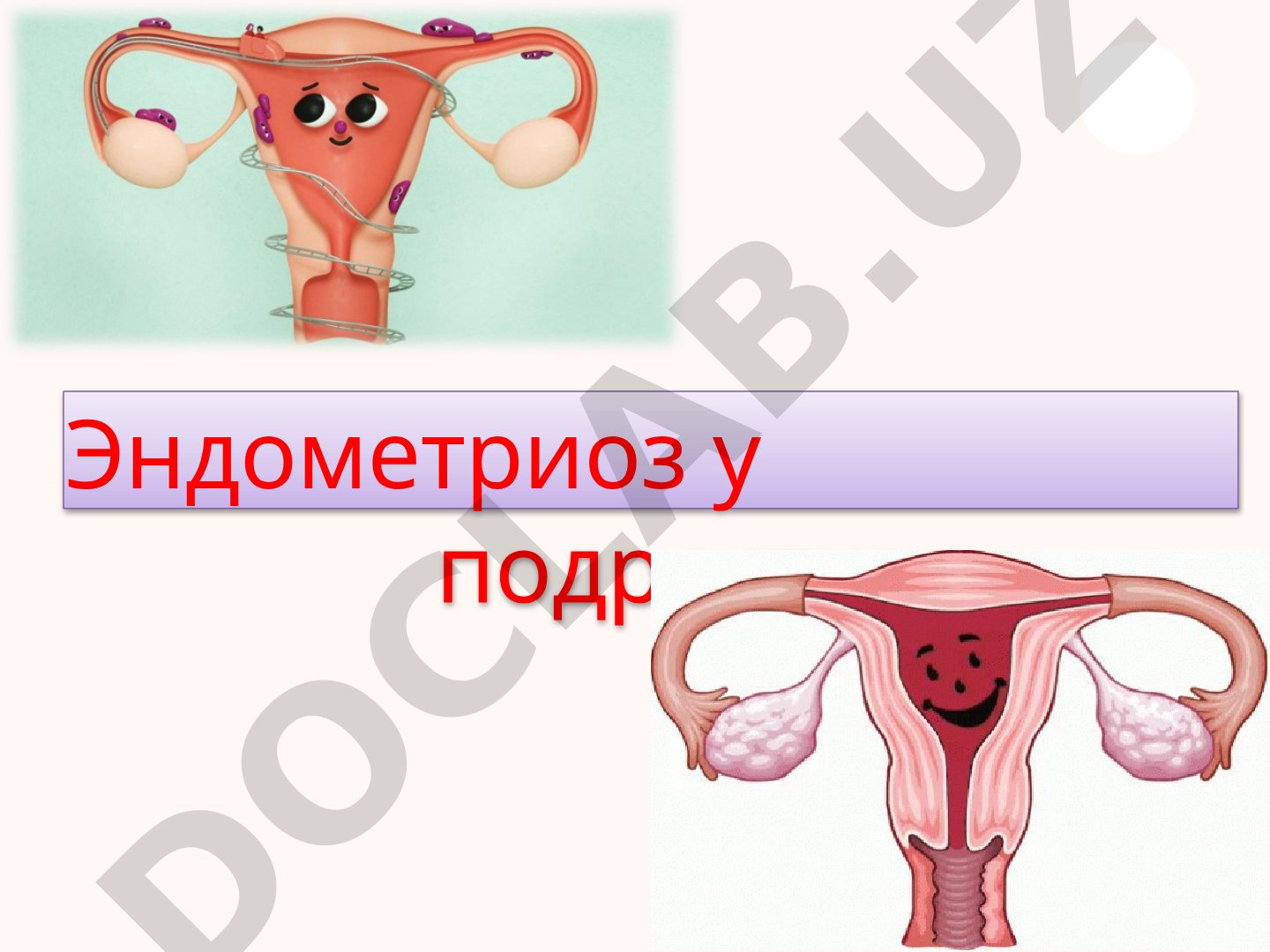 Эндометриоз у подростков
