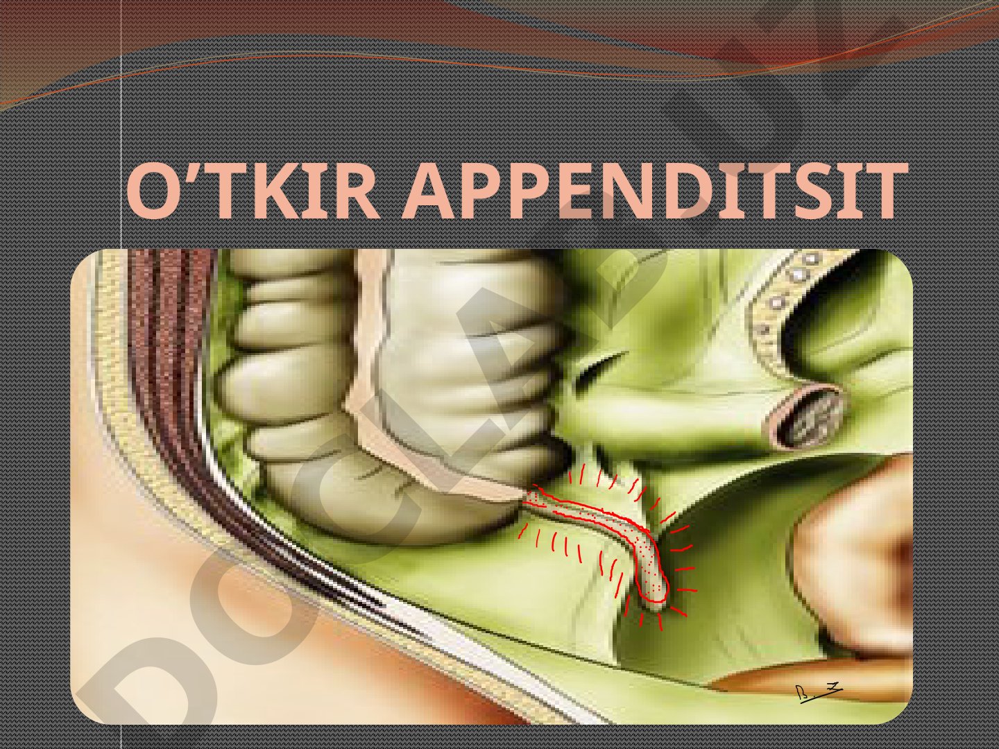 O'tkir appenditsit: ta'rifi, tarqalishi, anatomiyasi