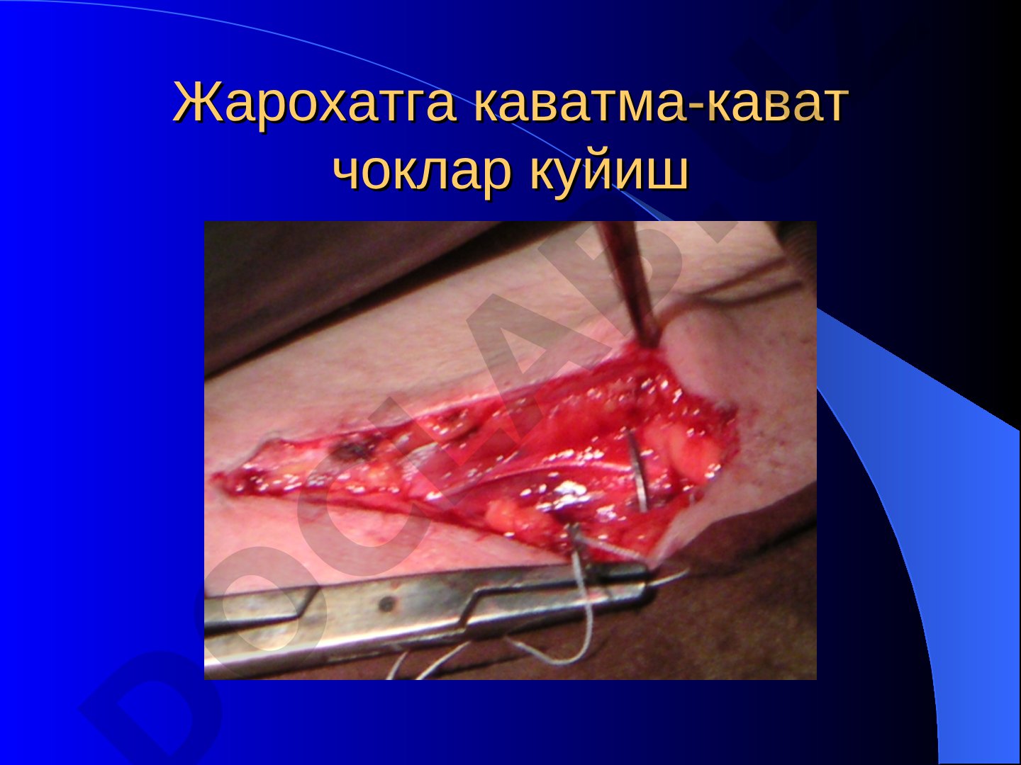 Жарохатга каватма-кават чоклар куйиш