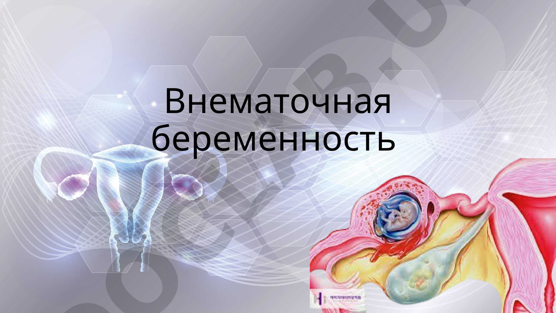 Внематочная беременность