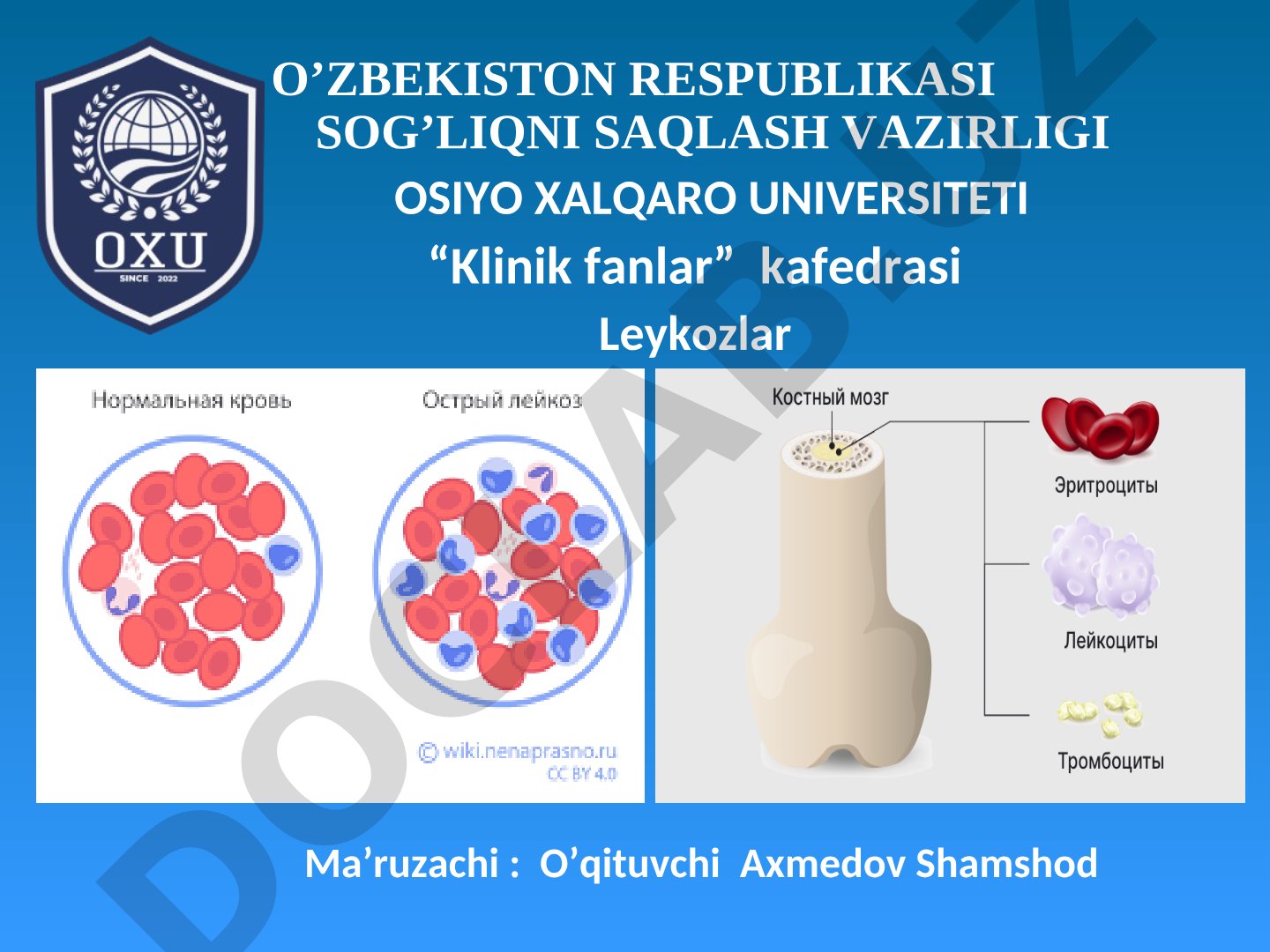 Оқ қон. Лейкоз касалликлари.