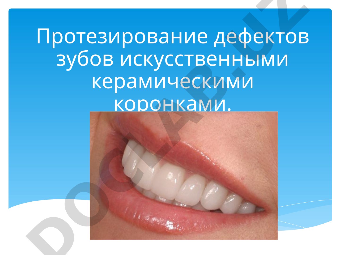 Протезирование дефектов зубов искусственными керамическими коронками