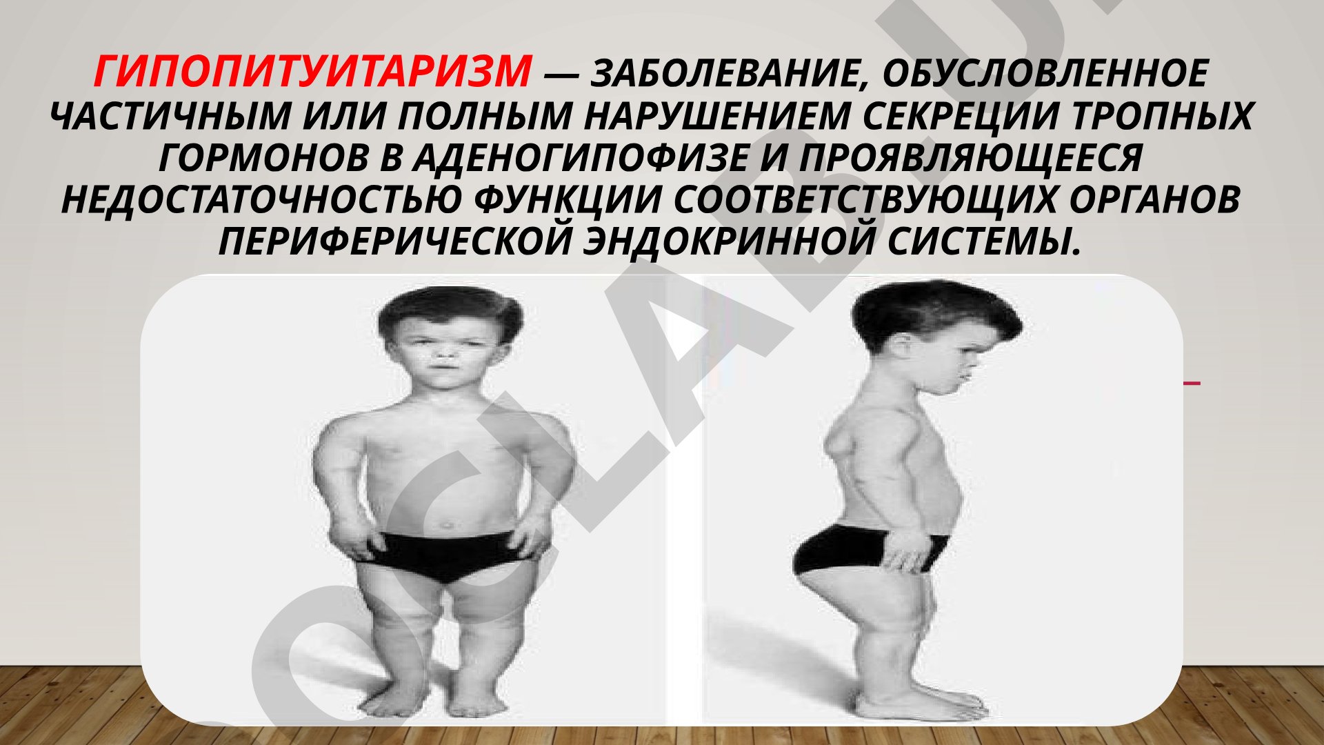 Гипопитуитаризм: этиология, патогенез, классификация