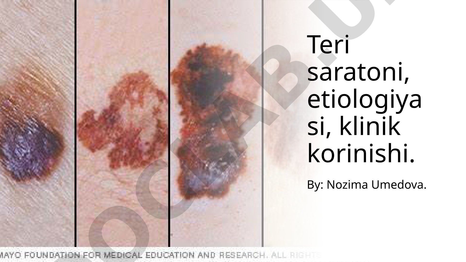 Teri saratoni, etiologiyasi, klinik ko'rinishi