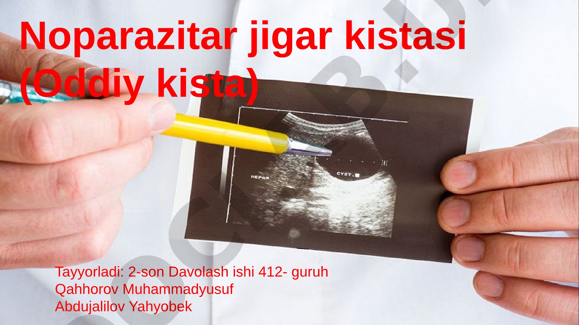 Noparazitar jigar kistasi (Oddiy kista)