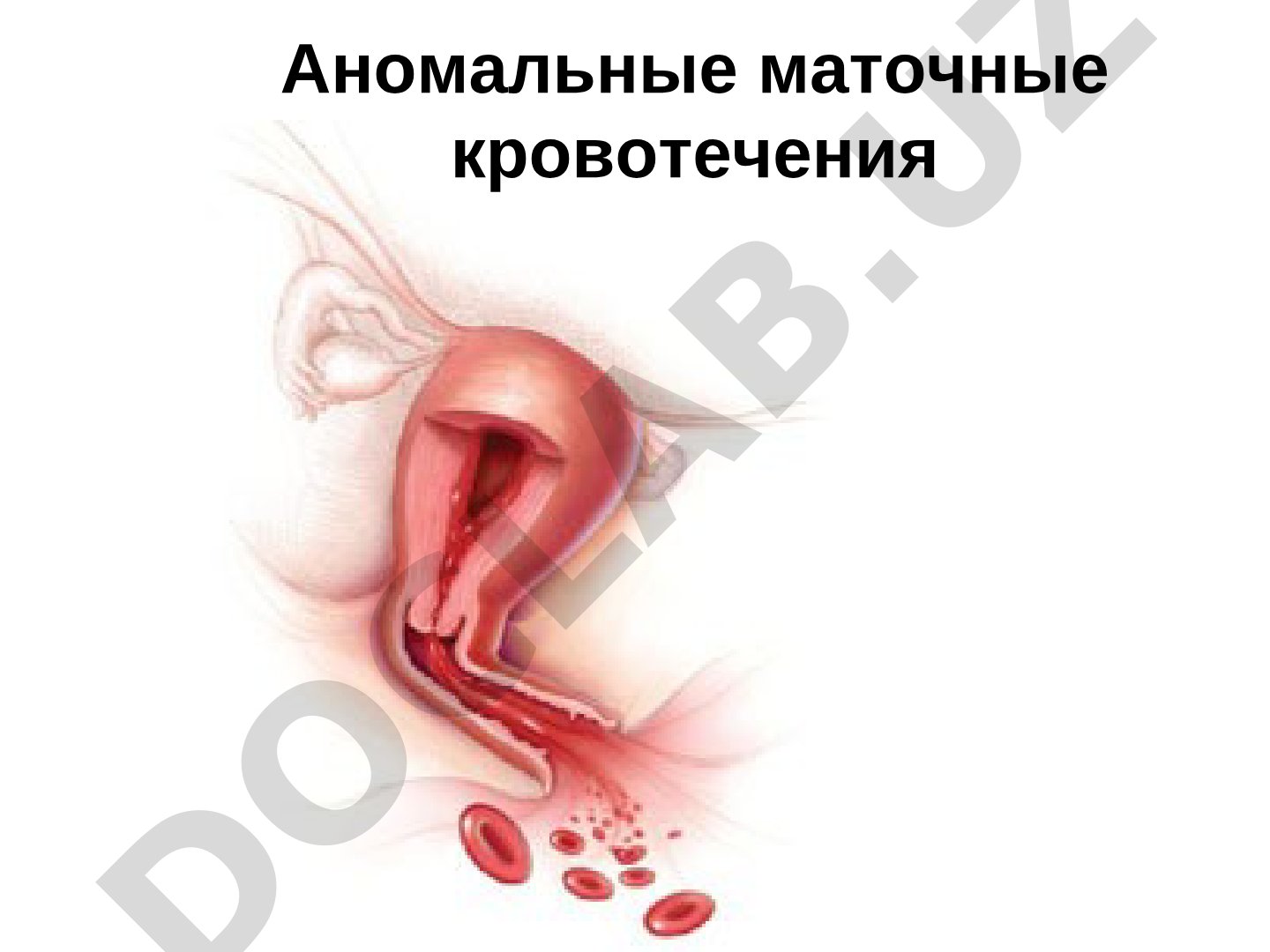 Аномальные маточные кровотечения