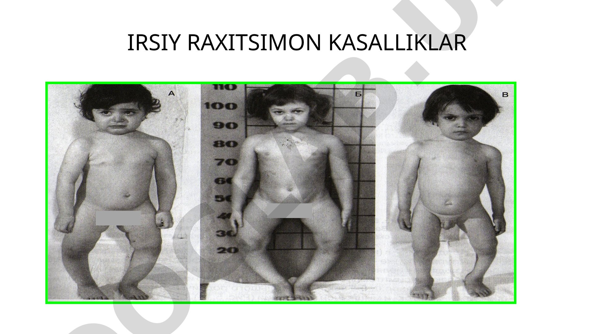 Irsiy raxitsimon kasalliklar D vitaminga rezistent raxit (DVRR, fosfat diabet)