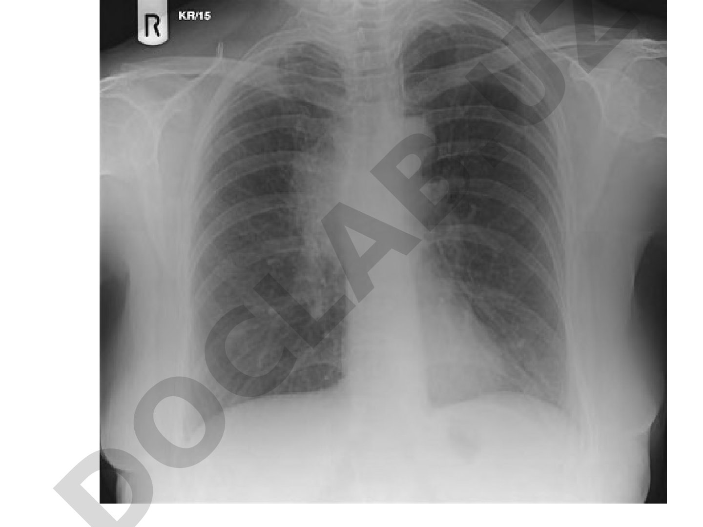 Portable Chest X-ray AP Sitting and PA Erect Views
