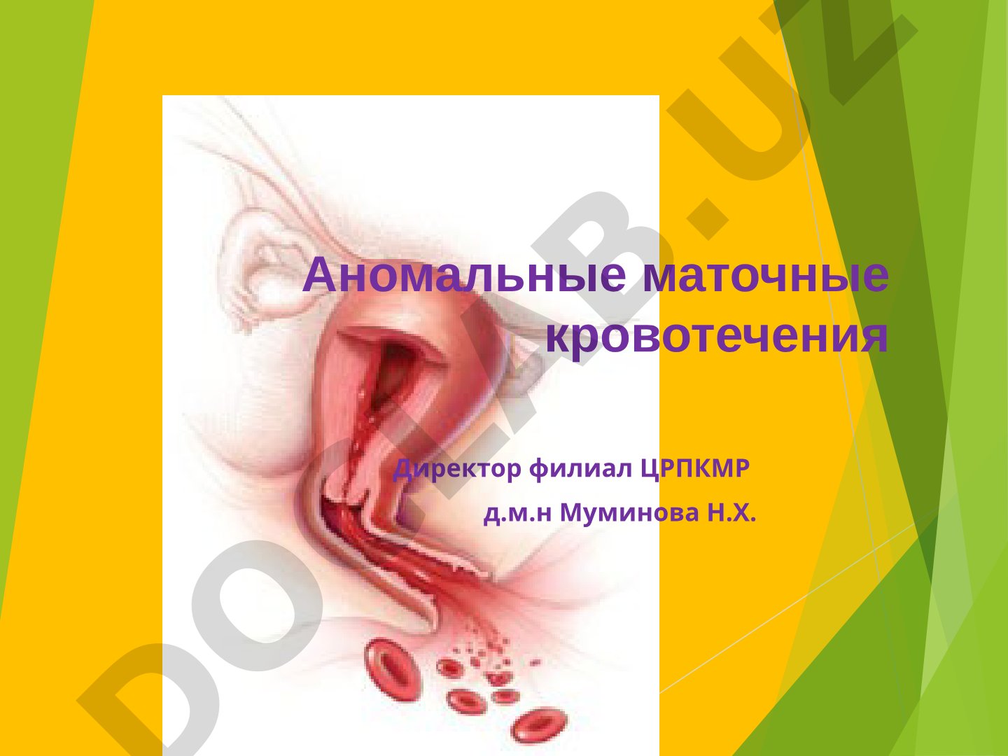 Аномальные маточные кровотечения