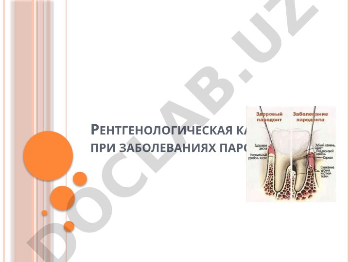Рентгенологическая картина при заболеваниях пародонта