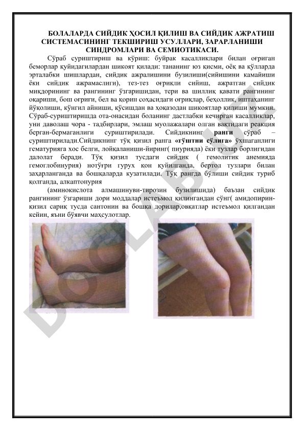 БОЛАЛАРДА СИЙДИК ҲОСИЛ ҚИЛИШ ВА СИЙДИК АЖРАТИШ СИСТEМАСИНИНГ ТEКШИРИШ УСУЛЛАРИ, ЗАРАРЛАНИШИ СИНДРОМЛАРИ ВА СEМИОТИКАСИ