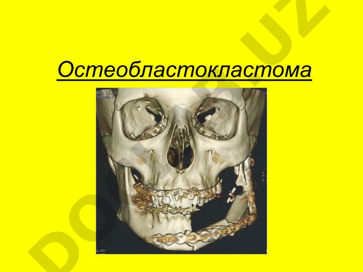 Остеобластокластома: симптомы, локализация и клинические проявления