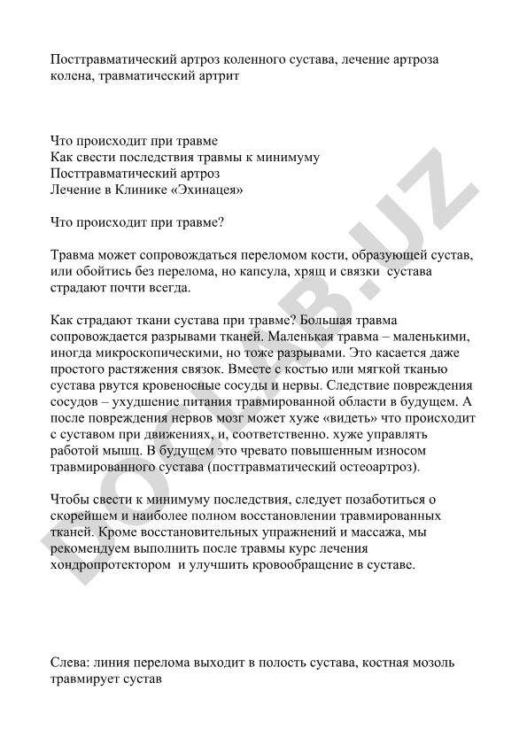 Посттравматический артроз коленного сустава и его лечение