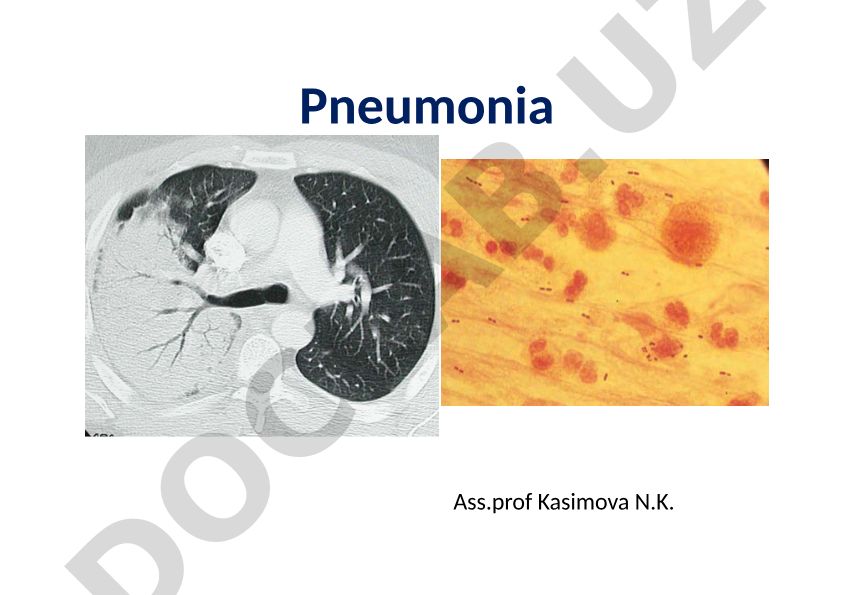 Pneumonia: Types, Causes and Clinical Presentation
