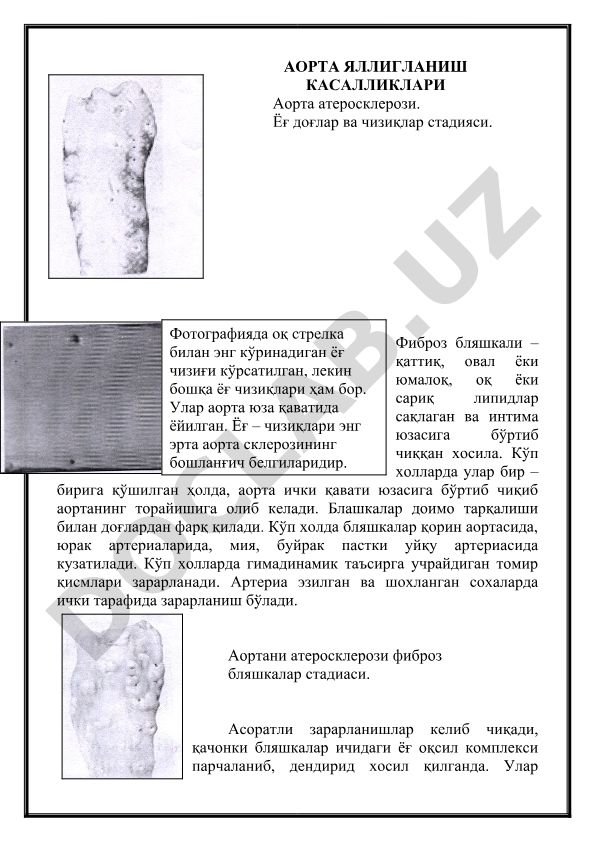 Аорта атеросклерози ва аорта яллиғланиш касалликлари