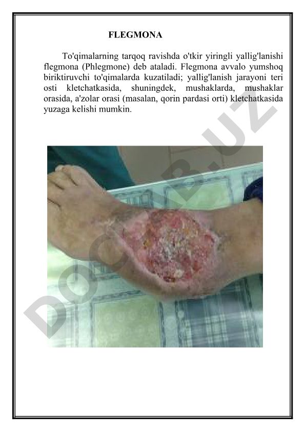 Flegmona: to'qimalarning yiringli yallig'lanishi