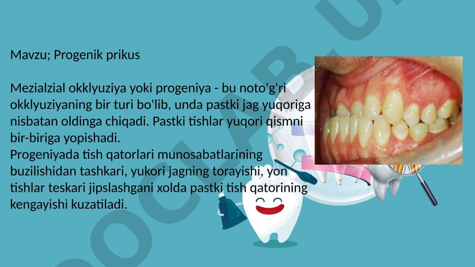 Progenik prikus Mezialzial okklyuziya yoki progeniya