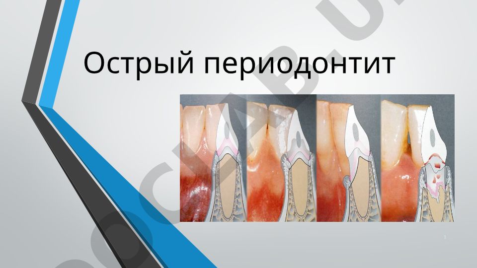 Ostriy periodontit: simptomlar va umumiy ma'lumotlar