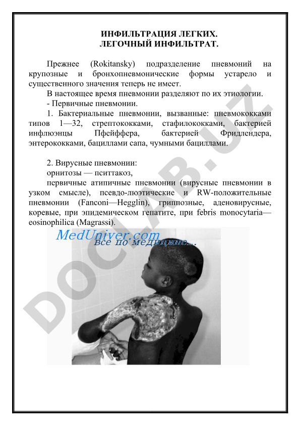 Инфильтрация легких и легочный инфильтрат: классификация пневмоний по этиологии