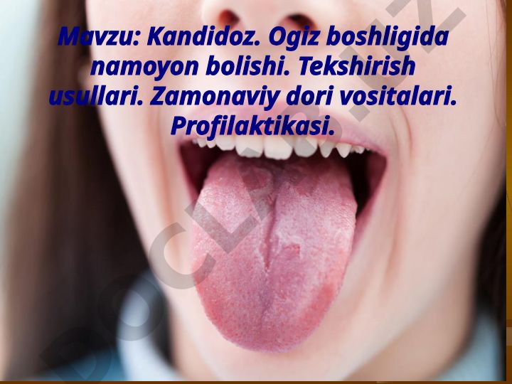Kandidoz. Ogiz boshligida namoyon bolishi. Tekshirish usullari. Zamonaviy dori vositalari. Profilaktikasi