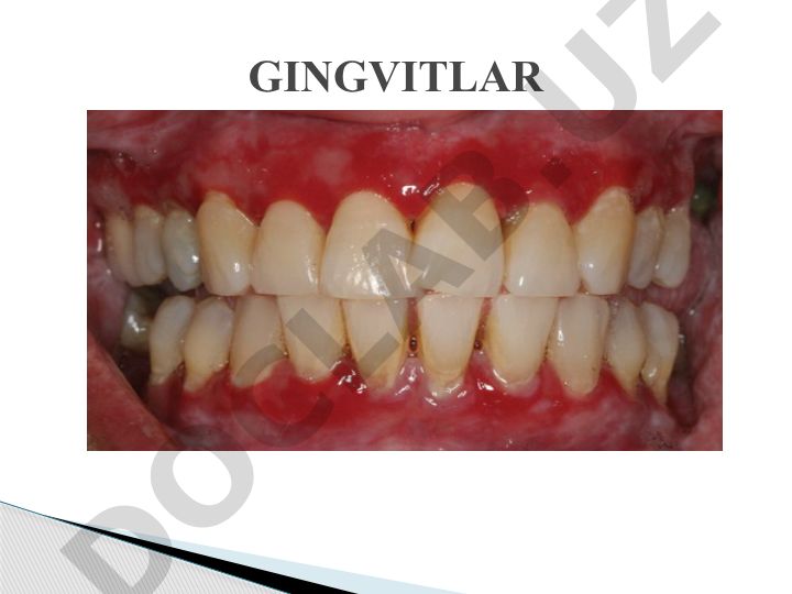Gingivit (milk yallig'lanishi) sabablari va rivojlanishi