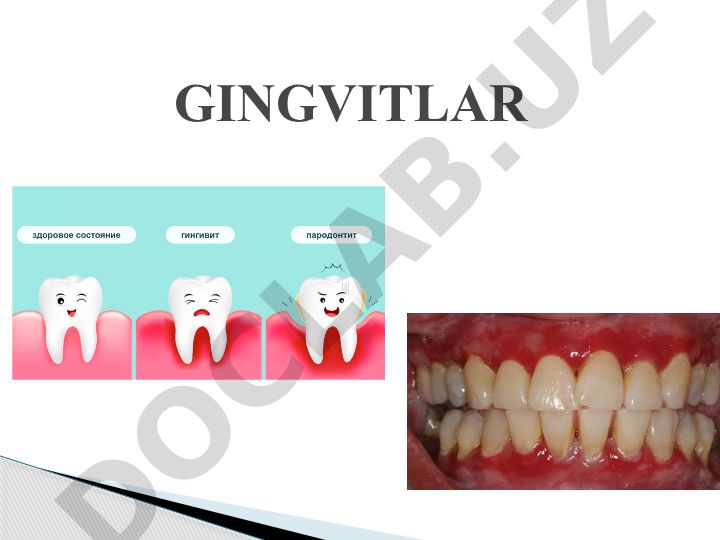 Gingivitlar: sabablari, belgilari va rivojlanishi